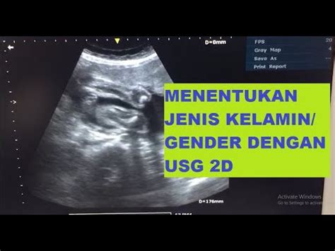 CARA MENENTUKAN JENIS KELAMIN GENDER DENGAN USG 2D YouTube