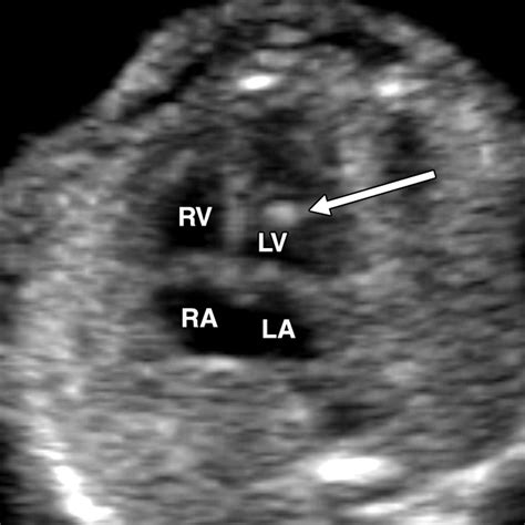 Ultrasound Of Fetal Cardiac Anomalies Ajr