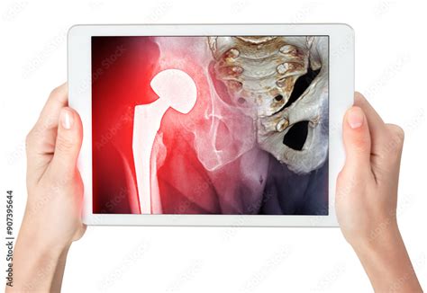 A Tablet Screen With A X Ray Right Hip Joint Ap View Showing Right Hip