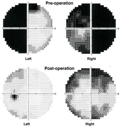 Visual field tests before and after pituitary surgery. The results of ...