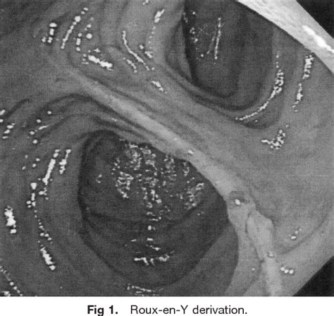 Figure From Single Balloon Enteroscopy For Treating Roux En Y