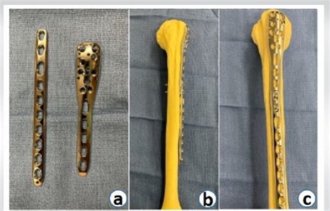 A B C Implants Utilized Synthes 35 Mm Lcp Proximal Humerus Plate