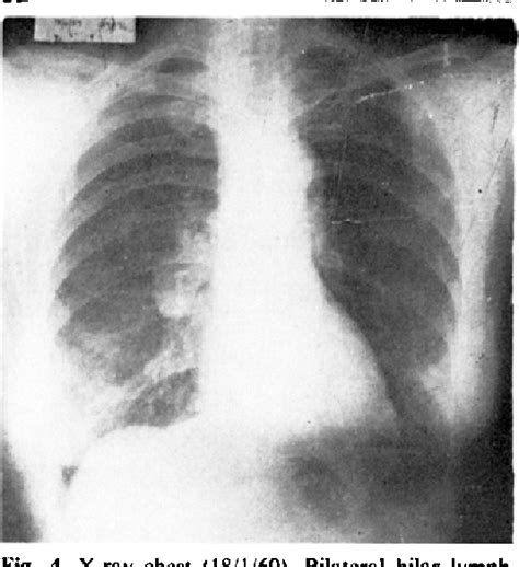 Figure 4 From Sarcoidosis Presenting With Unilateral Hilar Lymph Node Enlargement Report Of A