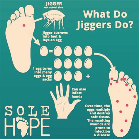 TZ woman found with over 1,000 jiggers “eating” her feet and hands - MedicoPressTZ