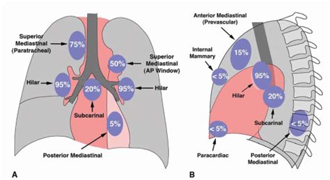 Sarcoidosis Lymph Nodes