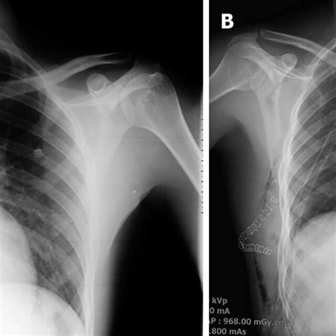 Posteroanterior Chest X Rays After Surgery A Posteroanterior Chest Download Scientific