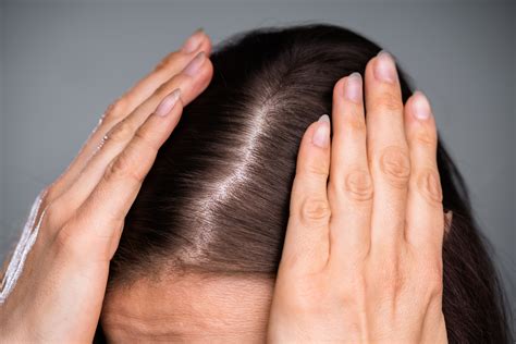 Normal Hair Parting Width Vs Thinning Causes Treatments And Results