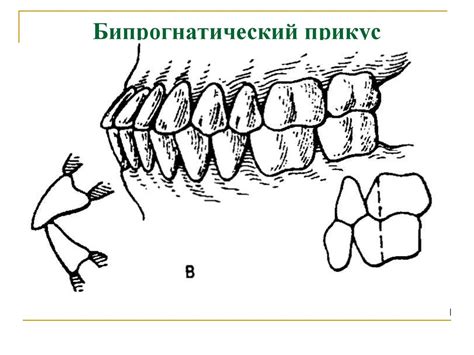 Прикус. Виды прикуса. Окклюзия. Виды окклюзии - презентация онлайн