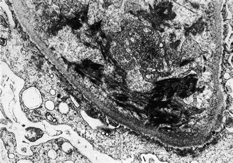 AJKD Atlas Of Renal Pathology Thrombotic Microangiopathy American