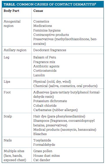 Contact Dermatitis