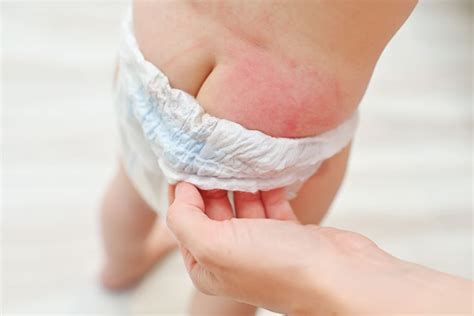 Yeast Diaper Rash Candida Diaper Dermatitis Symptoms Causes