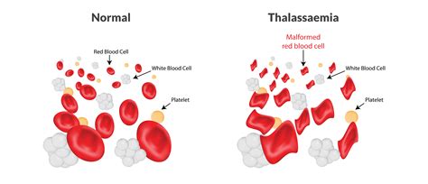 5 Common Thalassaemia Questions Cfch Singapore