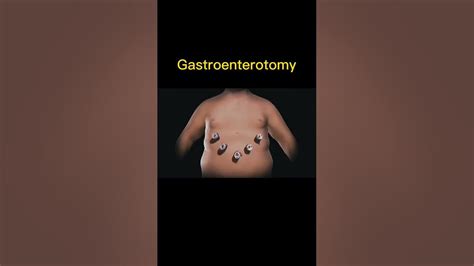 Gastroenterostomy - YouTube