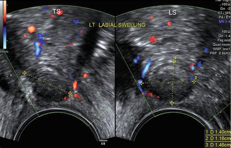 Ultrasound Evaluation Of The Vagina Springerlink