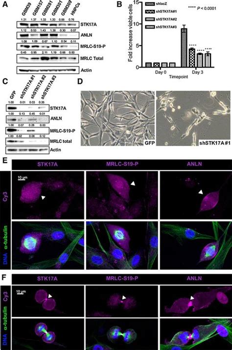 Drakstk17a Drives Neoplastic Glial Proliferation Through Modulation Of