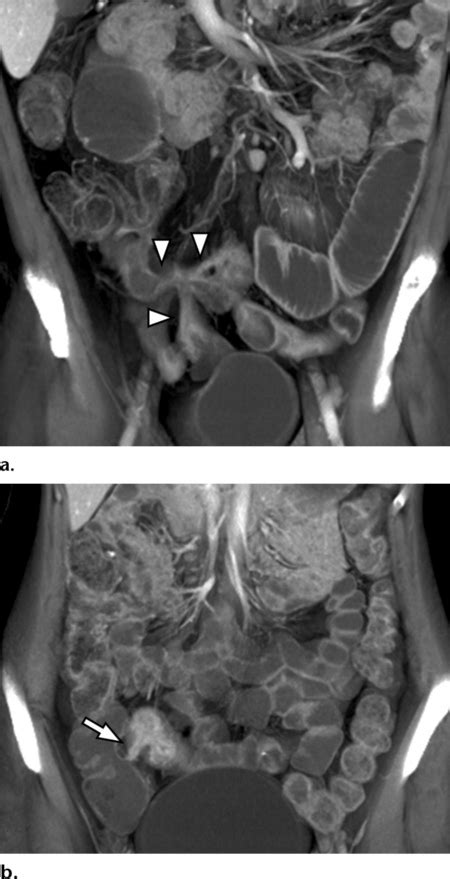 Fistula Formation In Crohn Disease Coronal Volume Rendered Ct