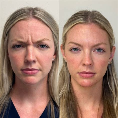 Before And After Photos Skn At Franks Dermatology