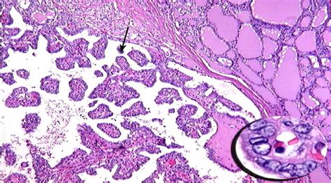 Papillary Thyroid Carcinoma