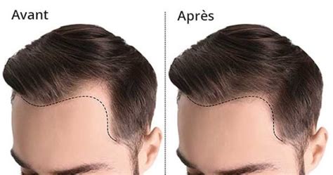 Les Meilleures Approches Pour La Perte Des De Cheveux Leman Aesthetic