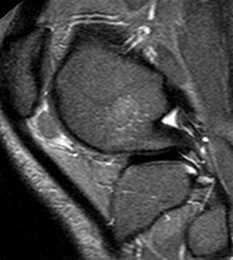 Pigmented Villonodular Synovitis Radsource