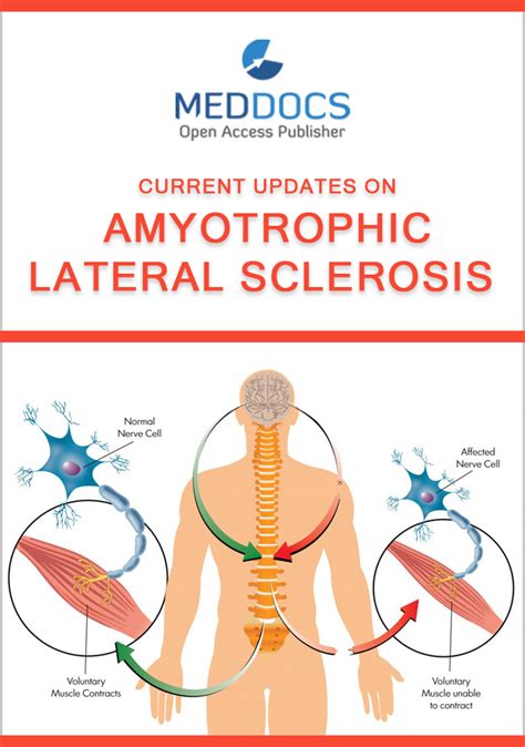 Current Updates On Amyotrophic Lateral Sclerosis