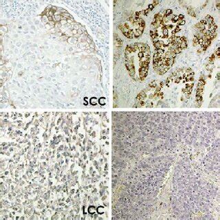 Immunohistochemical Staining For Activated Mtor P Mtor Focally