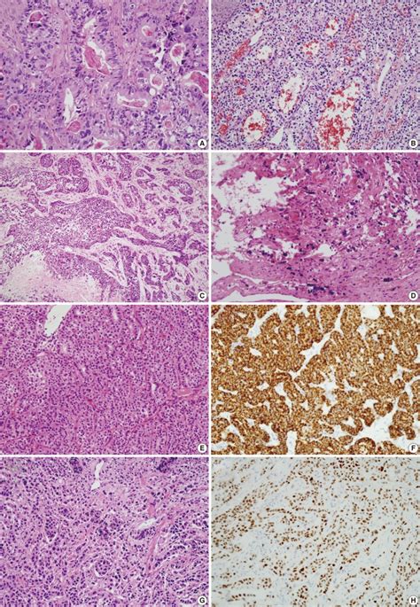 Metastatic Carcinomas To The Oral Cavity And Oropharynx Abstract