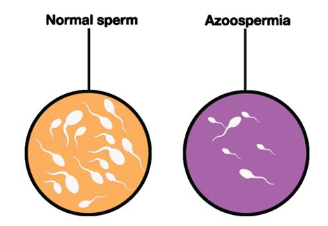 What Is Azoospermia How To Treat It Naturally Cac Herbal