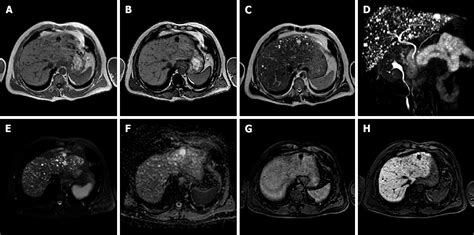 Benign Focal Liver Lesions The Role Of Magnetic Resonance Imaging