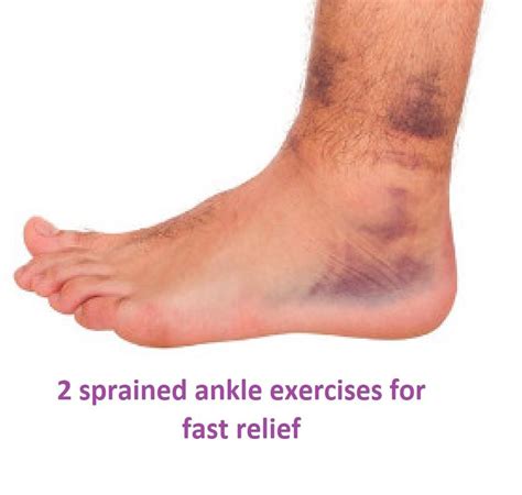 Ankle Sprain Grades Artofit