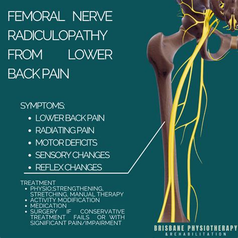 Femoral Nerve Radiculopathy From Lower Back Injury Brisbane