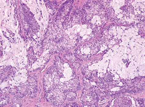 Mucoepidermoid Carcinoma Of The Parotid Gland The Mayo Clinic Experience Head And Neck