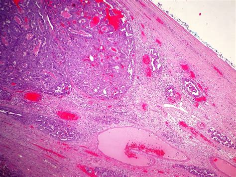 Embryonal carcinoma, testis – BosnianPathology