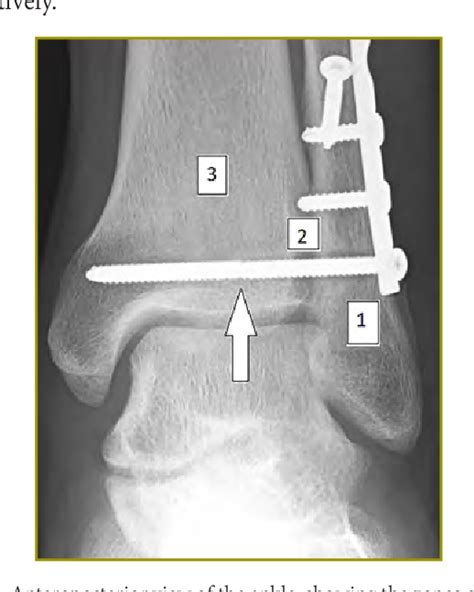 Figure 1 From Radiographic And Clinical Evaluation Of Syndesmotic