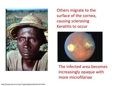 Ppt Onchocerciasis River Blindness” Powerpoint Presentation Free