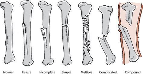 Broken Bones Skeleton Project