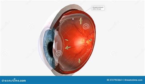 Glaucoma Human Eye Disease Vector Illustration 276072652