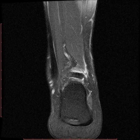 Posterior Ankle Impingement Image