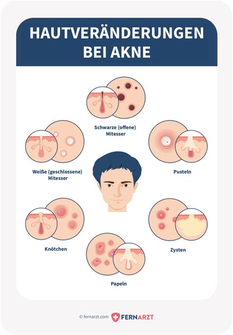 Akne Acne Vulgaris Symptome Ursachen Behandlung Fernarzt