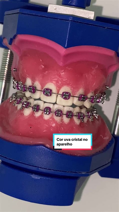 Tiktok · Dra Larissa Rodrigues In 2024 Braces Colors Getting Braces