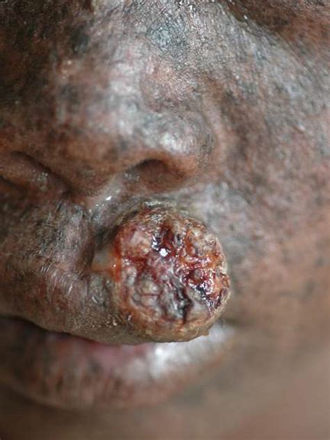 Xeroderma Pigmentosum