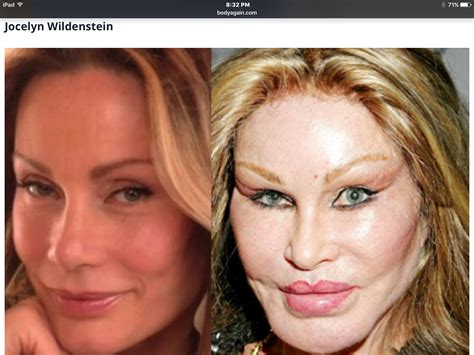 Pin by happygal831 on BEFORE. &. AFTER | Bad celebrity plastic surgery ...