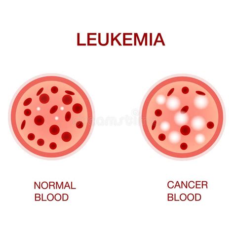 Infographic Image Of Leukemia Leukaemia Disease Awareness Realistic