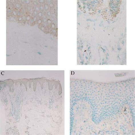 Immunohistochemical Staining Of Skin Biopsies A CCR4 Cells In