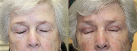 Blepharoplasty With Direct Brow Lift Eye Center South