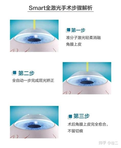 近视手术方式怎么选？全激光、全飞秒、半飞秒、icl晶体植入各自都有哪些优缺点？哪种方式更适合自己？ 知乎