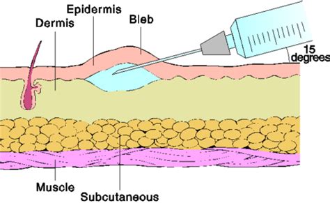 Parenteral Administration Intradermal Subcutaneous And Intramuscular