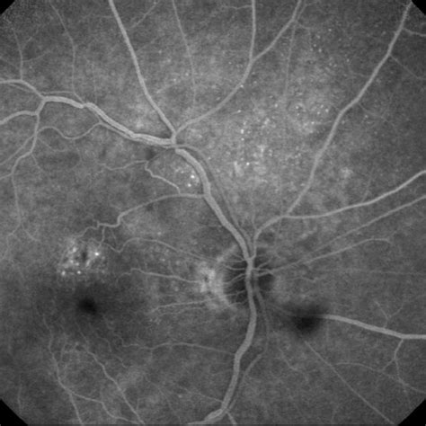 Late Phase Fluorescein Angiography Of Right Eye Showing Stippled