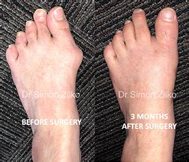 Minimally Invasive Bunion Surgery Perth Dr Simon Zilko St Mtp