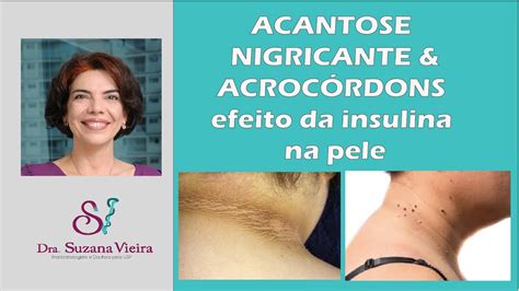 Acantose Nigricante E Acroc Rdons Skin Tags Efeito Do Excesso De